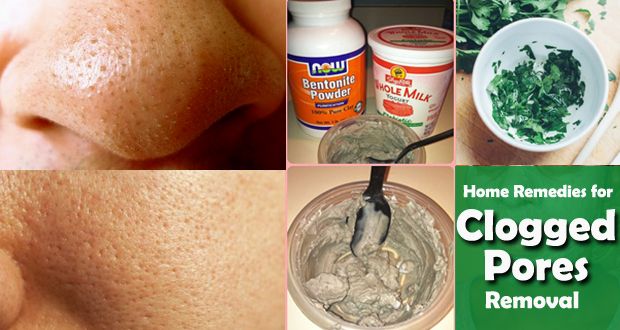 Top 12 remèdes maison pour les pores obstrués
