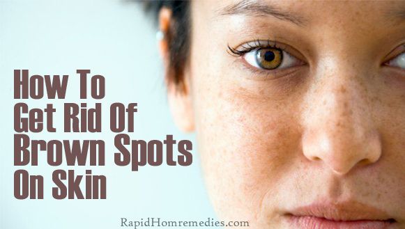 Top 7 des remèdes pour se débarrasser des taches brunes sur la peau